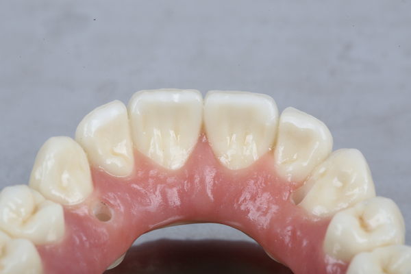 Do All On  ® Implants Look Natural?