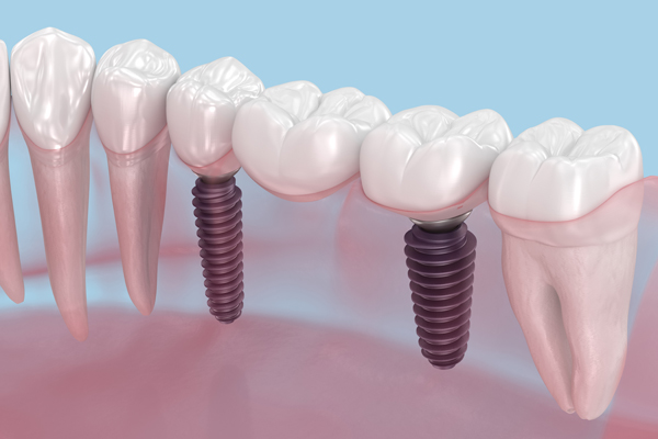 Missing A Single Tooth? Consider A Dental Implant