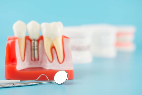 Why Dental Implants Are Comfortable And Secure