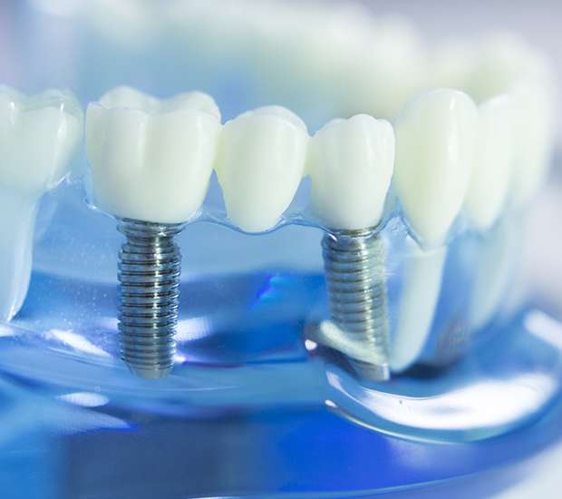 Tarzana Dental Implants