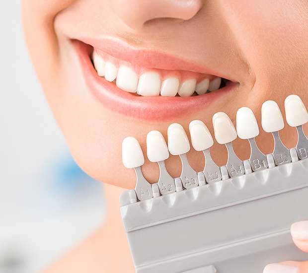 Tarzana Dental Veneers and Dental Laminates