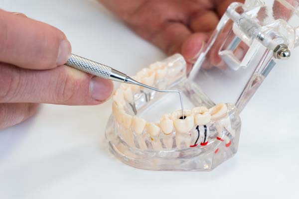 What Happens After The Root Canal Procedure?